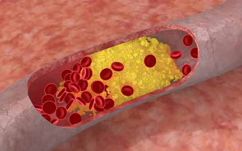 Podwyższony poziom cholesterolu - fakty i mity
